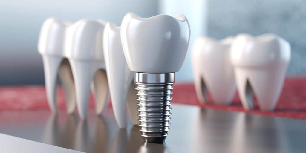 Dental Implant vs. Bridge: Pros and Cons, and which is the best for you ...